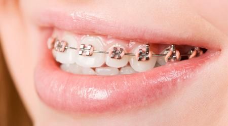 Clínica Dental Arucas tratamiento de ortodoncia